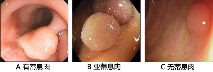 傅传刚教授解析大肠息肉的治疗方法和注意事项