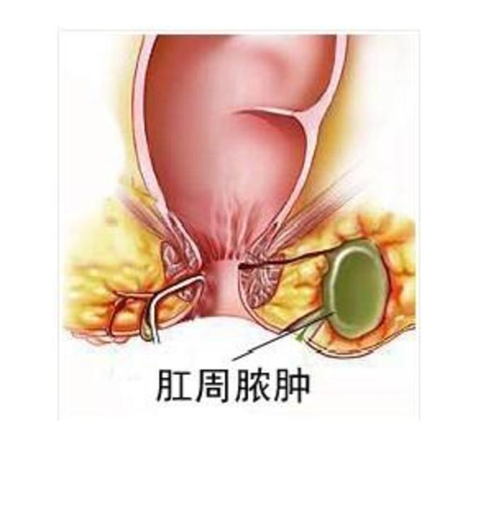 医生肛瘘是个什么鬼