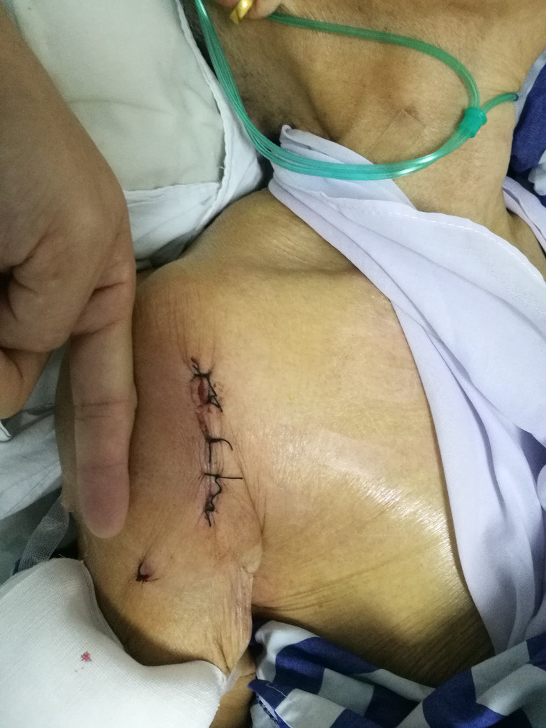 肩关节置换科普