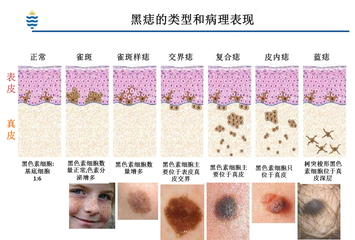 罗说黑痣 修复的方法--切除缝合,植皮,皮瓣还是扩张器?