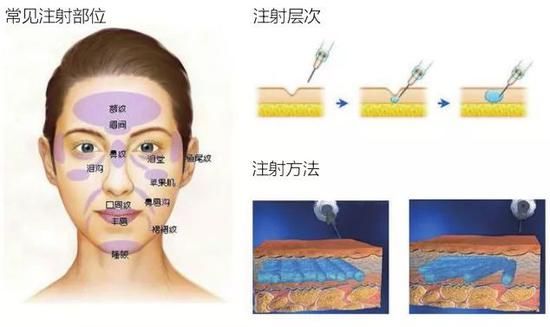 第一次注射玻尿酸一定要了解这几个方面