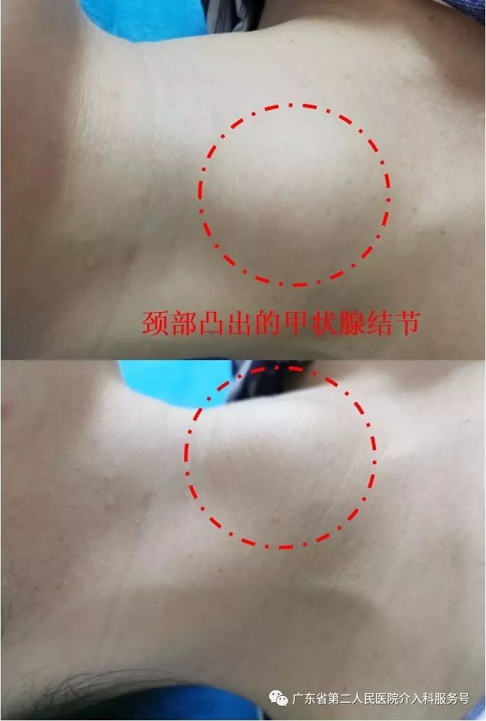 颈部凸出的随吞咽上下活动的很可能不是喉结而是甲状腺大结节哦