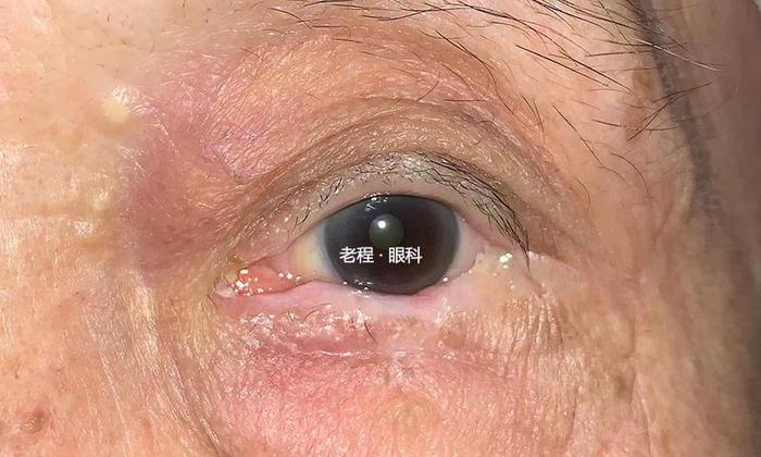 眼睑恶性肿瘤系列之鳞状细胞癌_程金伟医生文章_复旦大