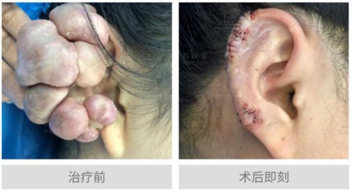 疤痕疙瘩长在耳朵上能治疗吗