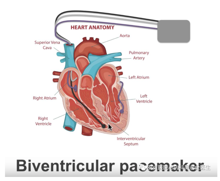 图7 三腔起搏器北京安贞医院吴永全主任团队安贞医院吴永全主任团队