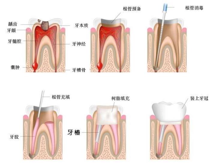 她才20岁经历了蛀牙成残根到拔掉