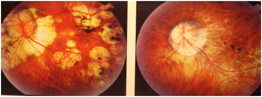 近视科普系列之五:说说后巩膜加固术治疗高度近视那点事 - 微医(挂号