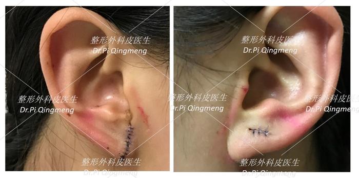 耳洞疤痕增生
