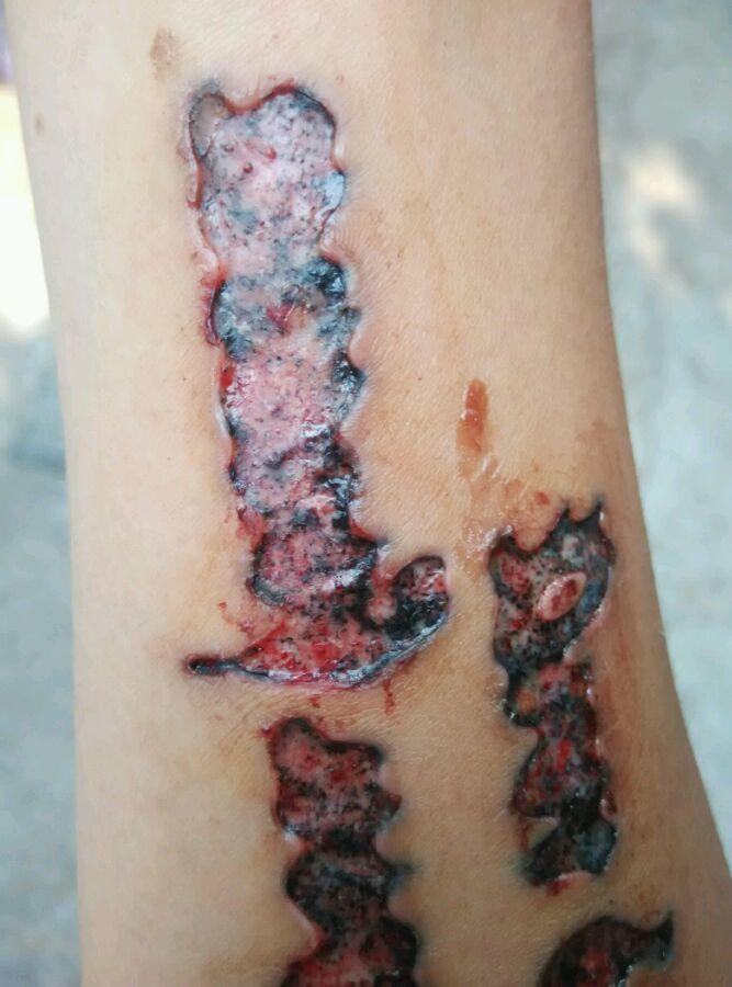 第三种不靠谱的方法是烧灼法,用烧红的烙铁甚至烟头将纹身连同皮肤一