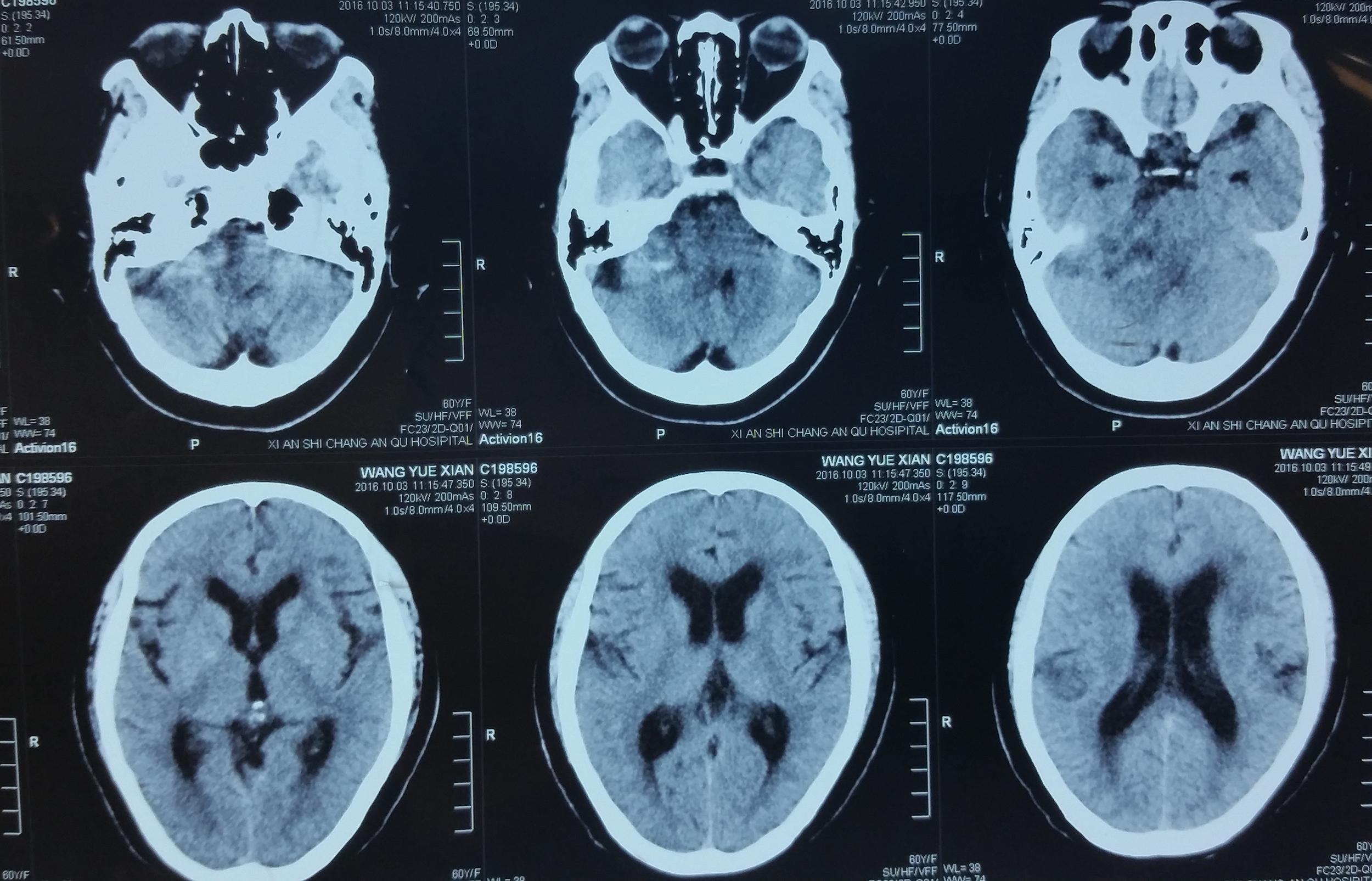 原发性中枢神经系统淋巴瘤的临床特点和影像特征分析