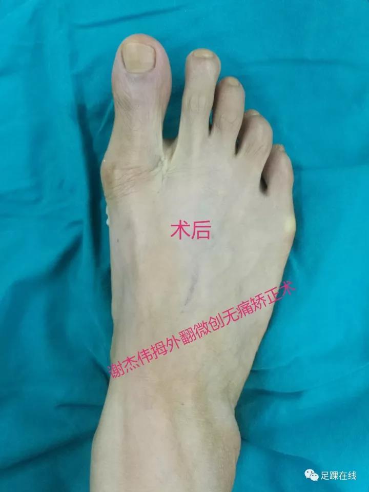 拇外翻俗称大脚骨的微创无痛美容矫正术