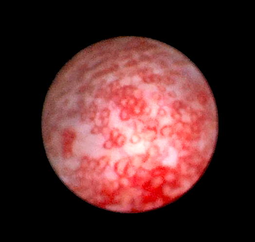 血尿的诊断和复杂性尿路感染的治疗