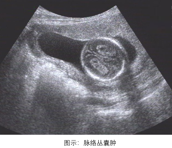 1984年chudleigh首次报道超声发现胎儿脉络丛囊肿,在妊娠中期较常见