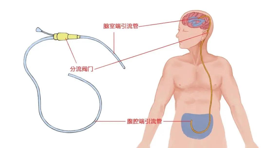 先天性脑积水患者这一路是怎么走过来的