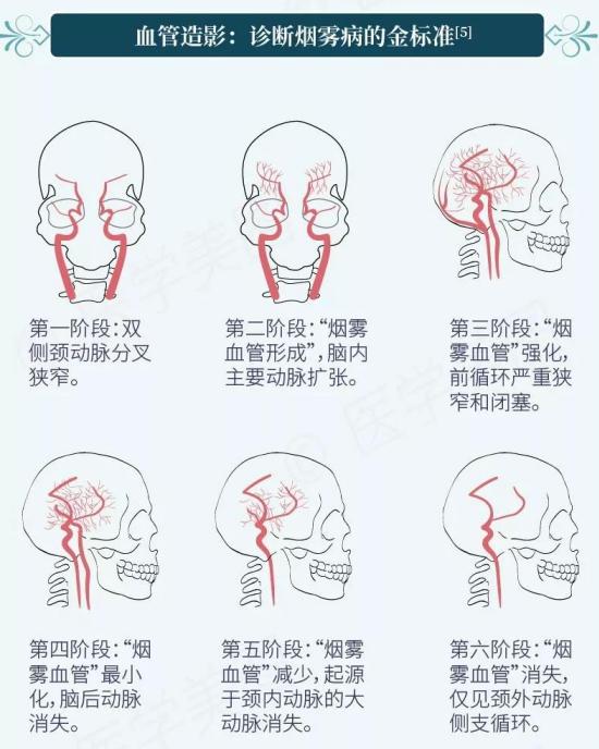 烟雾病是什么病怎么治疗