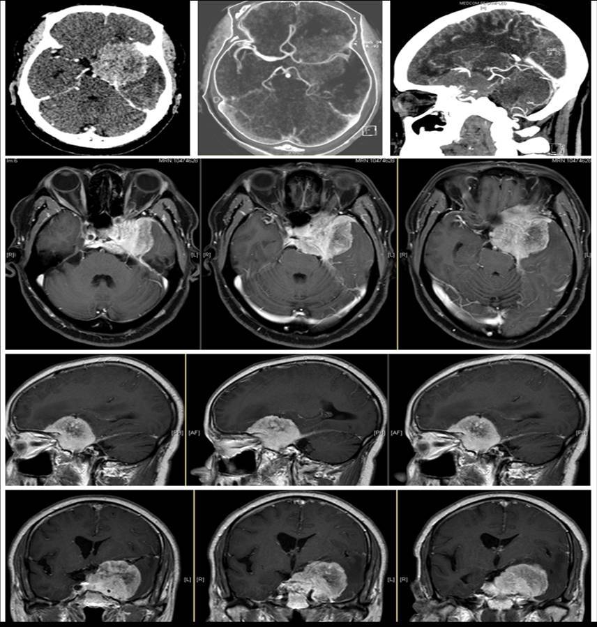 颅底肿瘤我们的特色连外国人都很信赖