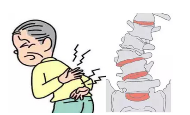 中老年人群注意了这种腰腿痛可能提示你腰椎退变性侧弯了