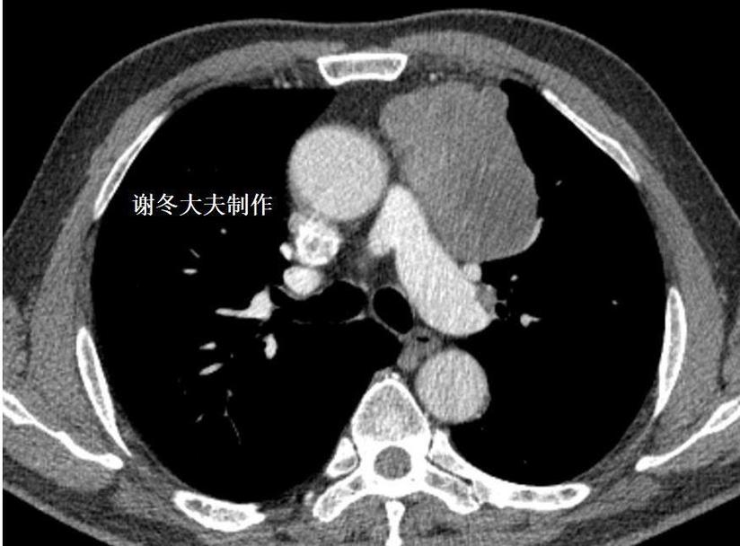 胸腺瘤 前纵隔占位 前纵隔结节 伴有肌无力是癌症吗 健康号 微医