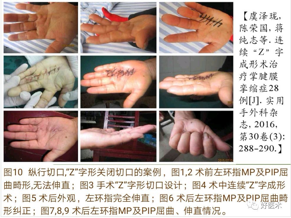 掌腱膜挛缩症的诊治技巧,系统详解!