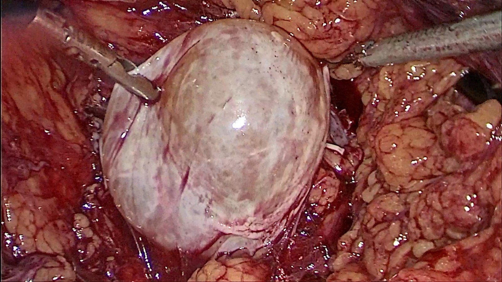 肾囊肿术后会复发和癌变吗