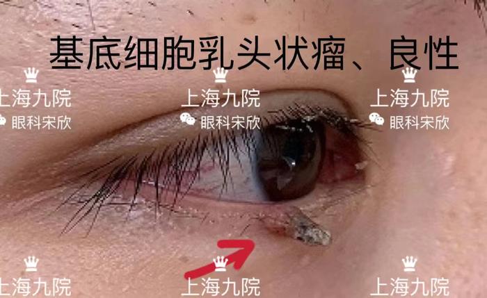 眼皮上奇奇怪怪的疙瘩都是什么常见眼睑肿瘤图片良恶性