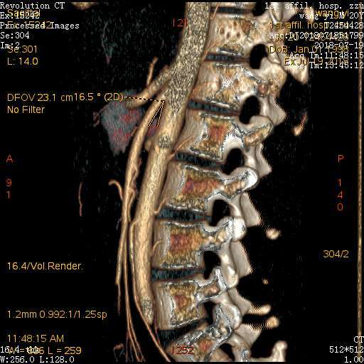 肠系膜上动脉压迫综合征良性十二指肠瘀滞症