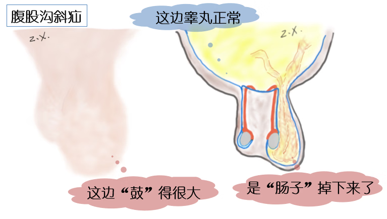 宝宝两边蛋蛋不一样大是怎么回事