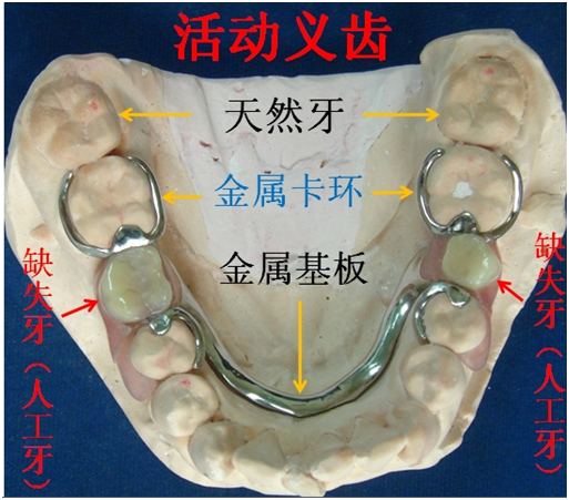 可摘义齿:又叫活动义齿,借助有弹性的卡环(钩子)把人工牙固位在缺牙