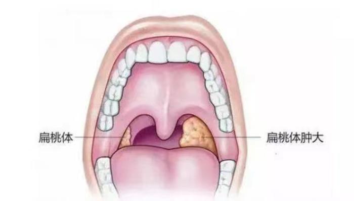 宝宝打鼾非小事警惕腺样体肥大