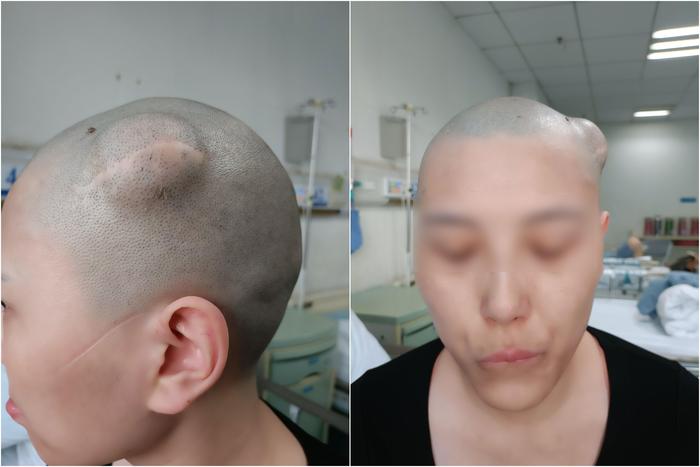 【典型病例】女子脑袋十年长出"鸡蛋"大骨瘤,唐都医院神经外科赵天智