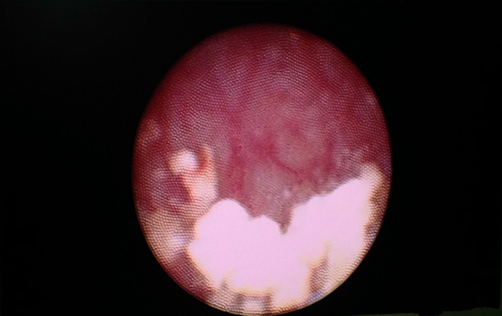 血精精囊炎的最新治疗手段精囊镜技术