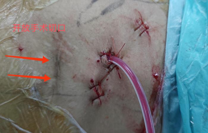 双镜联合顺行经皮肾镜联合逆行输尿管软镜治疗复杂肾结石典型病例分析