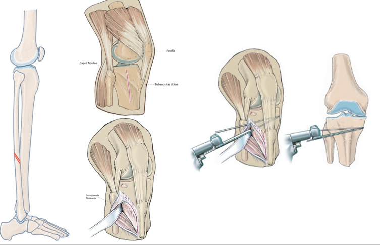 胫骨高位截骨术保膝治疗膝关节骨关节炎