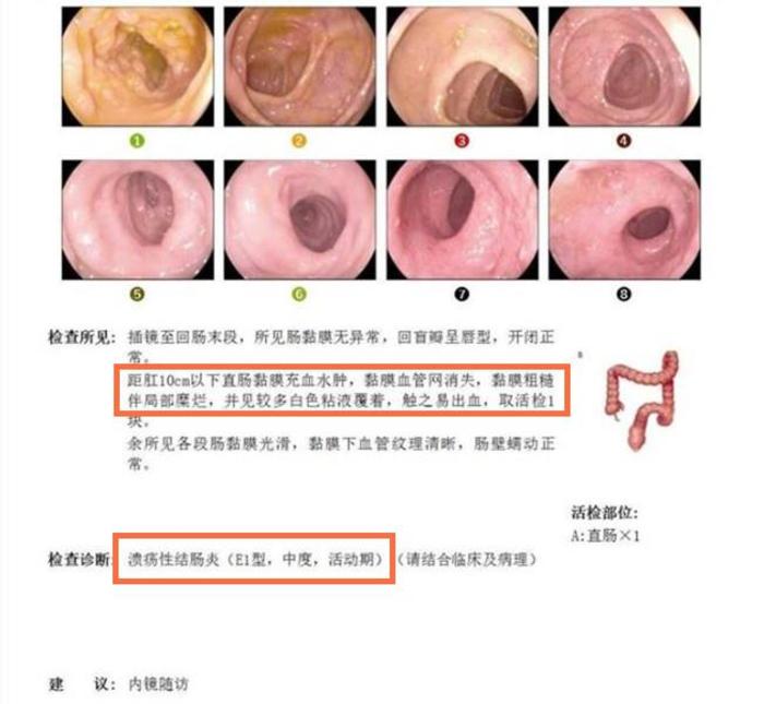 青玉散癒合5年慢性復發型直腸型潰瘍性結腸炎患者的腸道