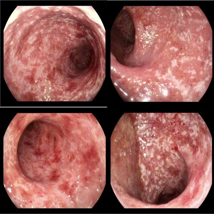 图1 初诊肠镜患者,男性,2019年12月确诊"溃疡性结肠炎"具体报告未见