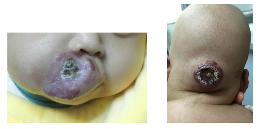 头部血管瘤综合治疗案例