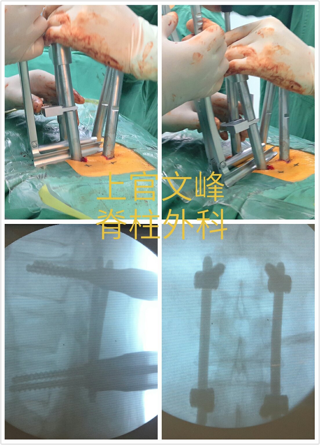 经皮置钉技术联合经皮骨水泥椎体成形术治疗胸腰椎骨折