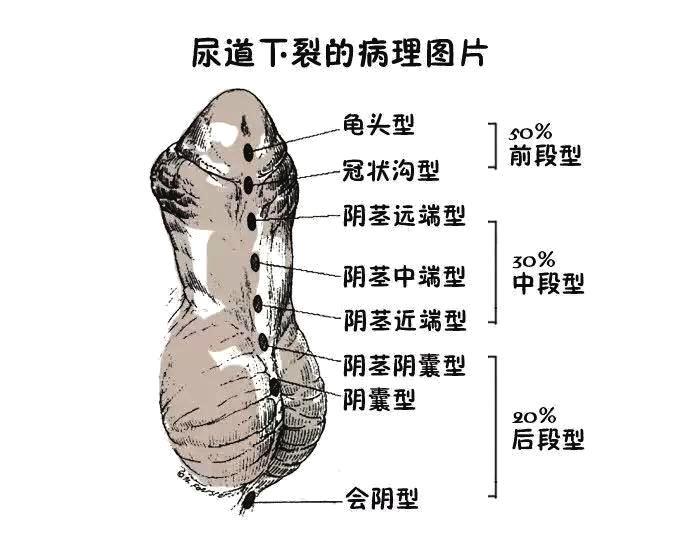 尿道口位置异常,正常人尿道口位于阴茎头顶,尿道下裂病人尿道口位置低