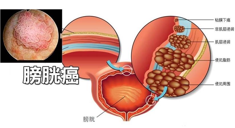 保膀胱还是切膀胱 医心和医术背后艰难的人性抉择 健康号 微医