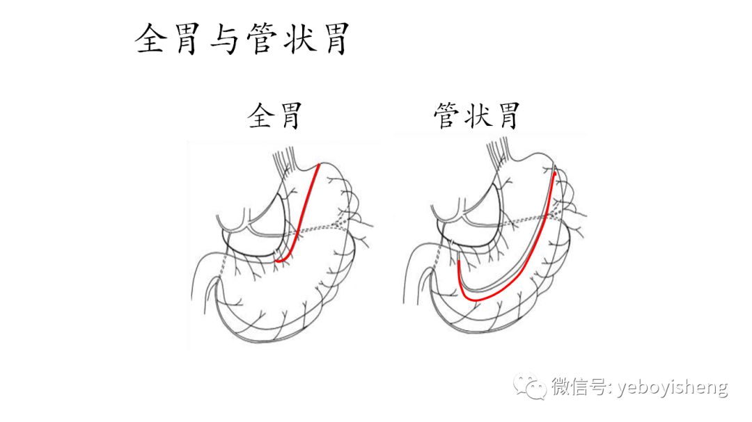 食管癌的管状胃替代