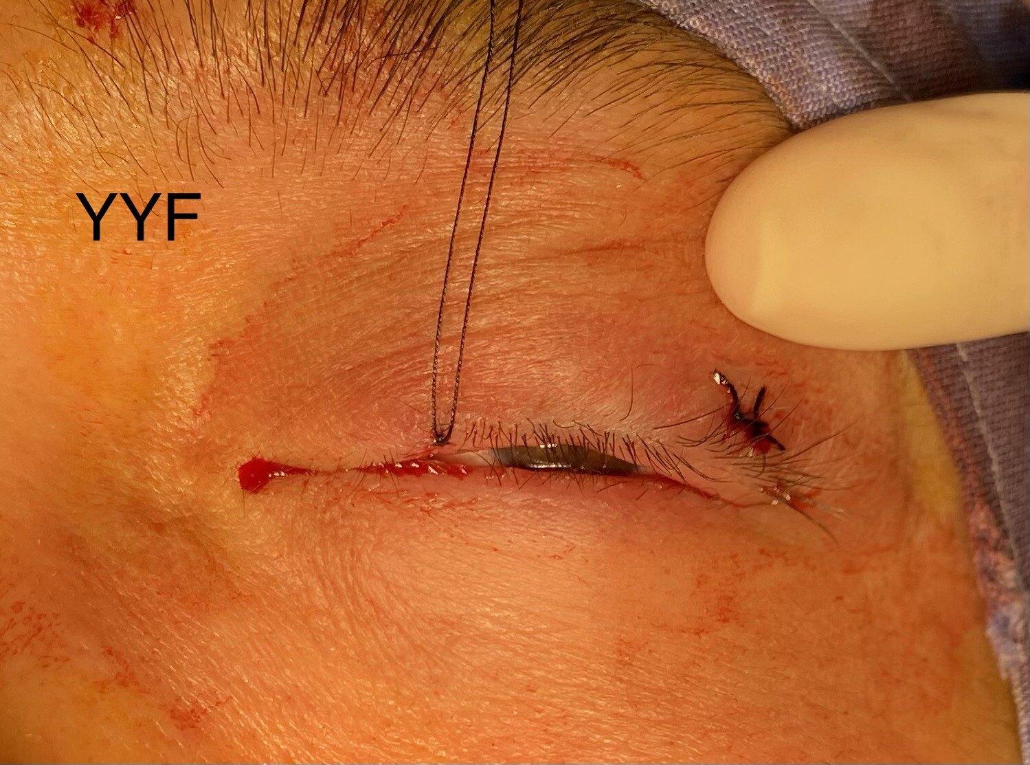 眼睑肿块系列之二睑缘霰粒肿手术宜早不宜迟