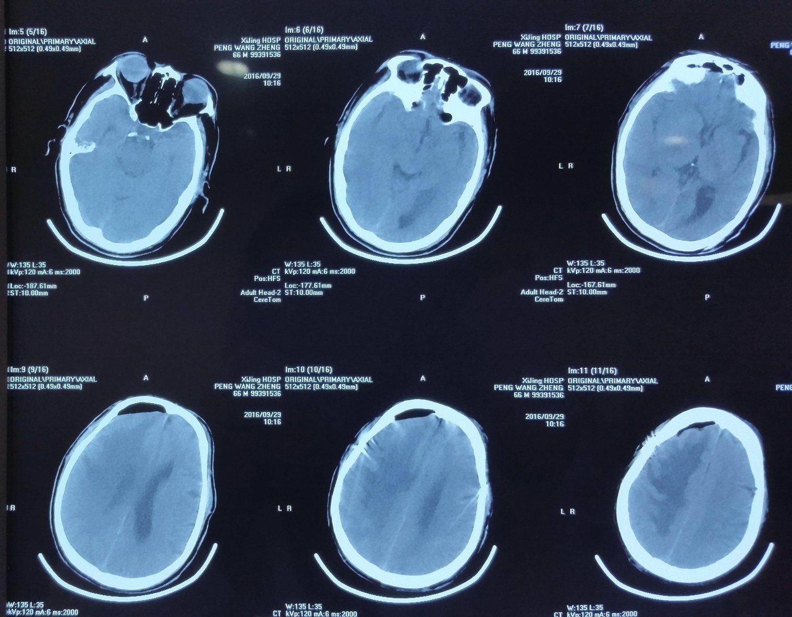 典型脑出血病例分享（含CT及MRI）_疾病分享_快速问医生