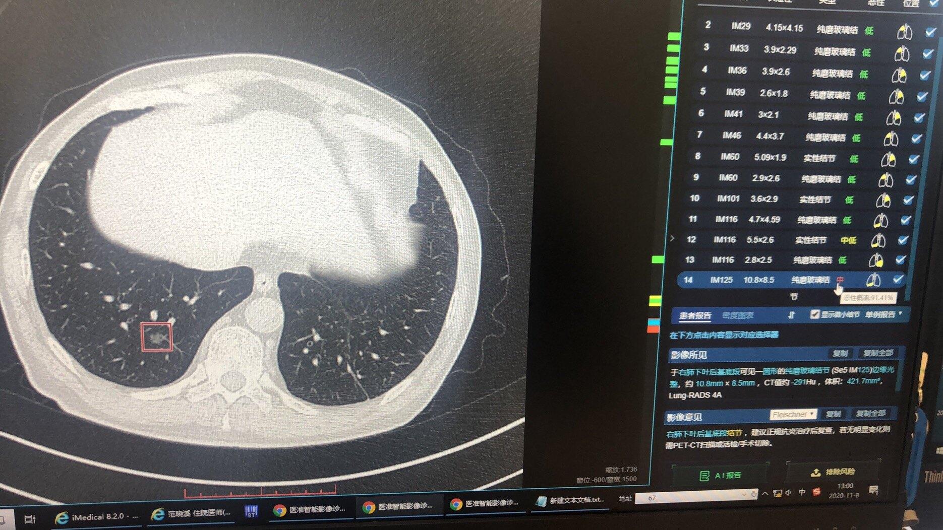 磨玻璃結節藉助ai人工智能輔助判定是否手術治療