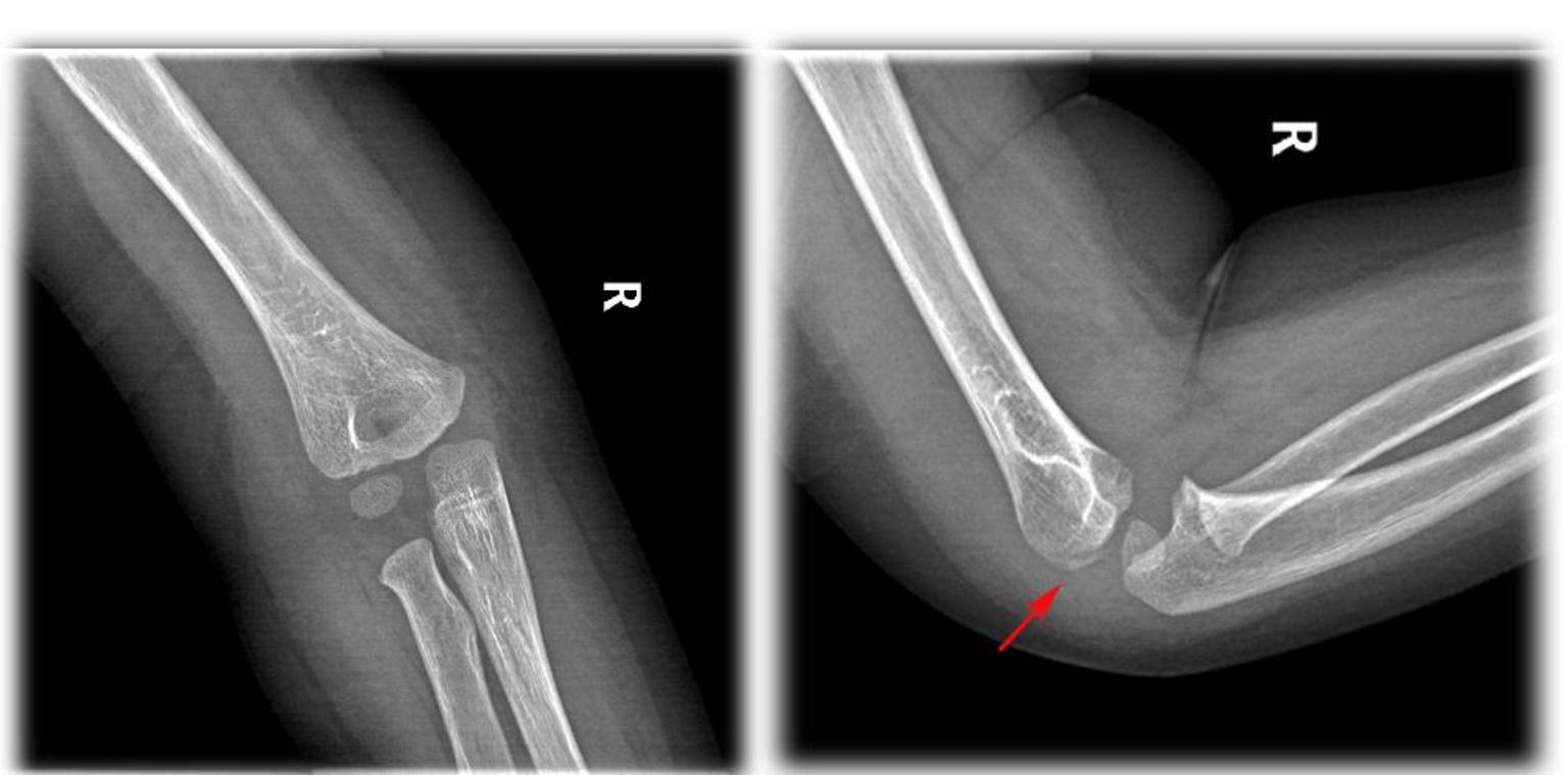 肱骨外髁骨折是什么病 如何来的诊断与治疗的 肱骨骨折 肱骨骨折