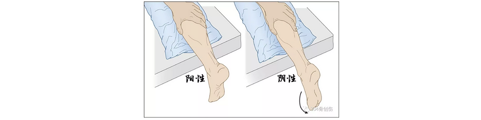 直腿伸踝试验图片