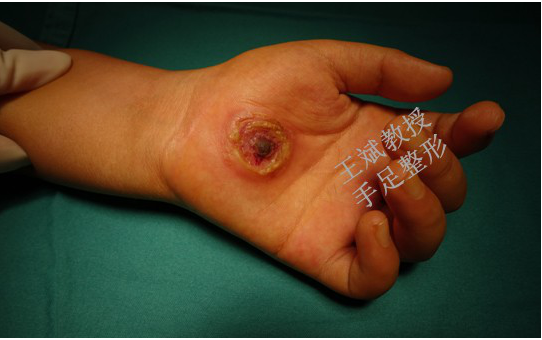 手上生疮非小事日常诊断要及时