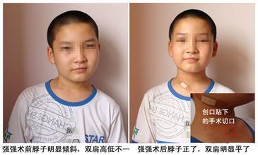 先天性枕颈部畸形所致,包括短颈畸形,颅底凹陷,半椎体畸形,寰枕融合及