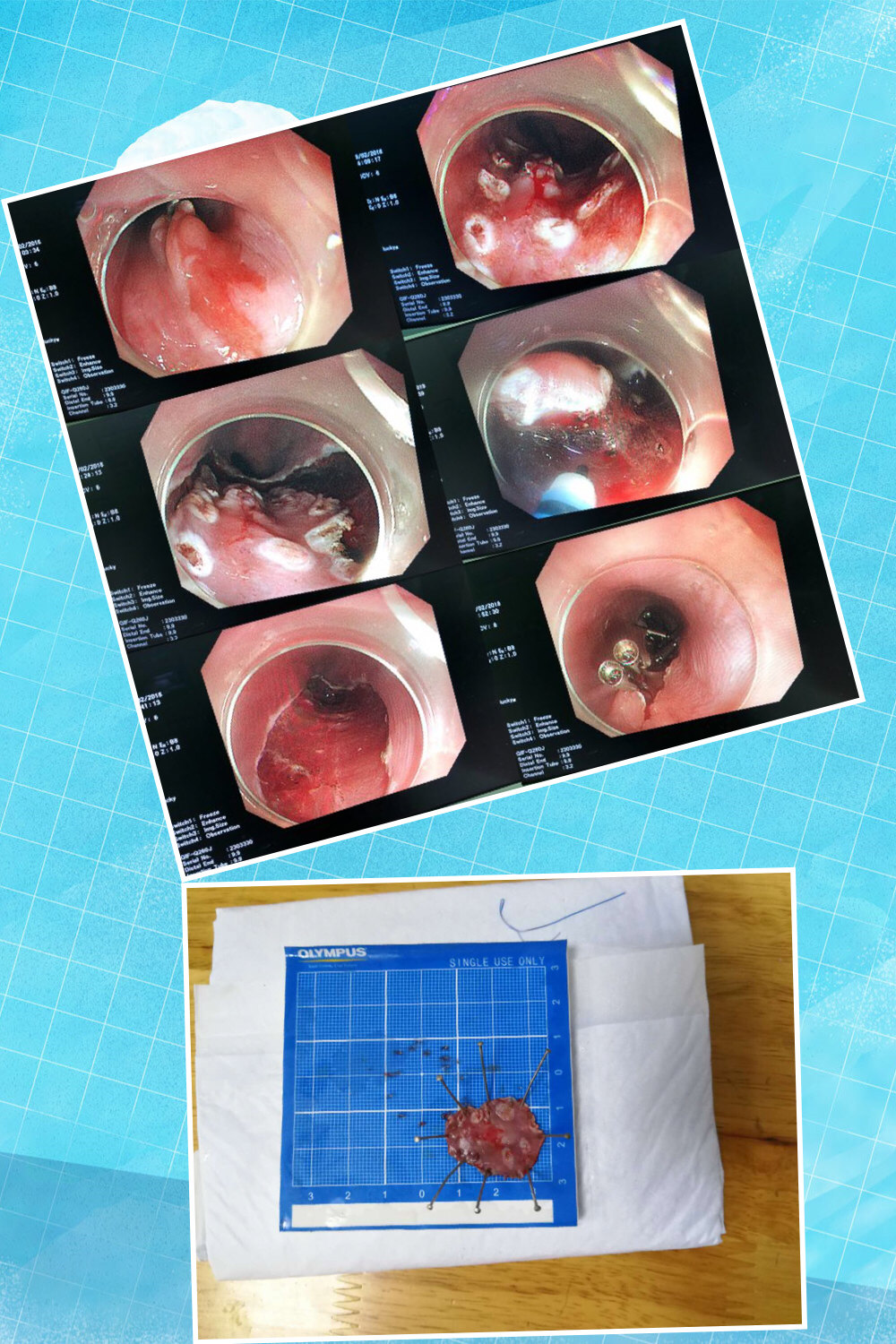 早期食管癌esd内镜下黏膜剥离术术后及预防