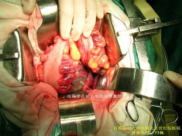 自发性结肠穿孔破裂