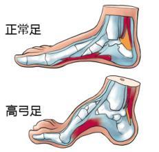 微創足踝外科特色之八高弓內翻足的微創手術